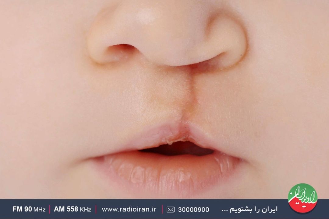  راهكار پیشگیری از بیماری شكاف لب یا كام باید بدانید در «رهاورد»