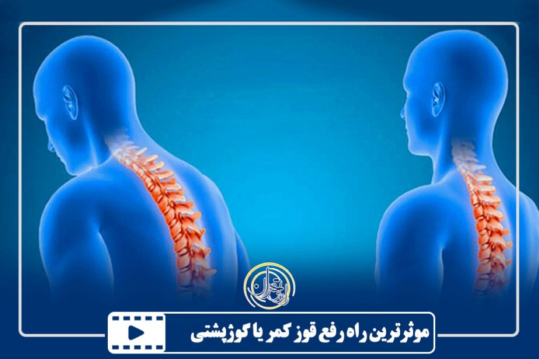 موثرترین راه رفع قوز كمر یا گوژپشتی