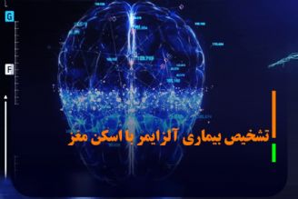 انقلابی در تشخیص آلزایمر: اسكن مغزی MRI مبتنی بر یادگیری ماشینی