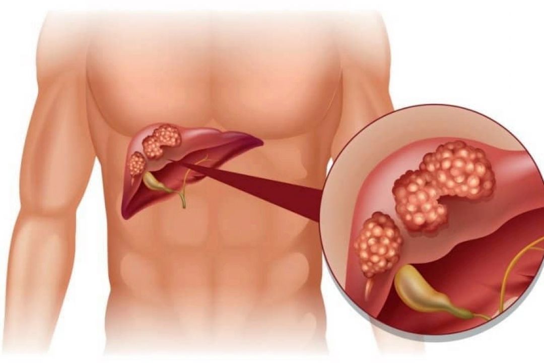 متاستاز كبدی چیست؟(علت، علائم، درمان)