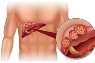 متاستاز كبدی چیست؟(علت، علائم، درمان)