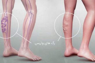 واریس و خطرات بی‌توجهی به درمان آن