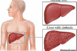 با كبد چرب چه كنیم؟