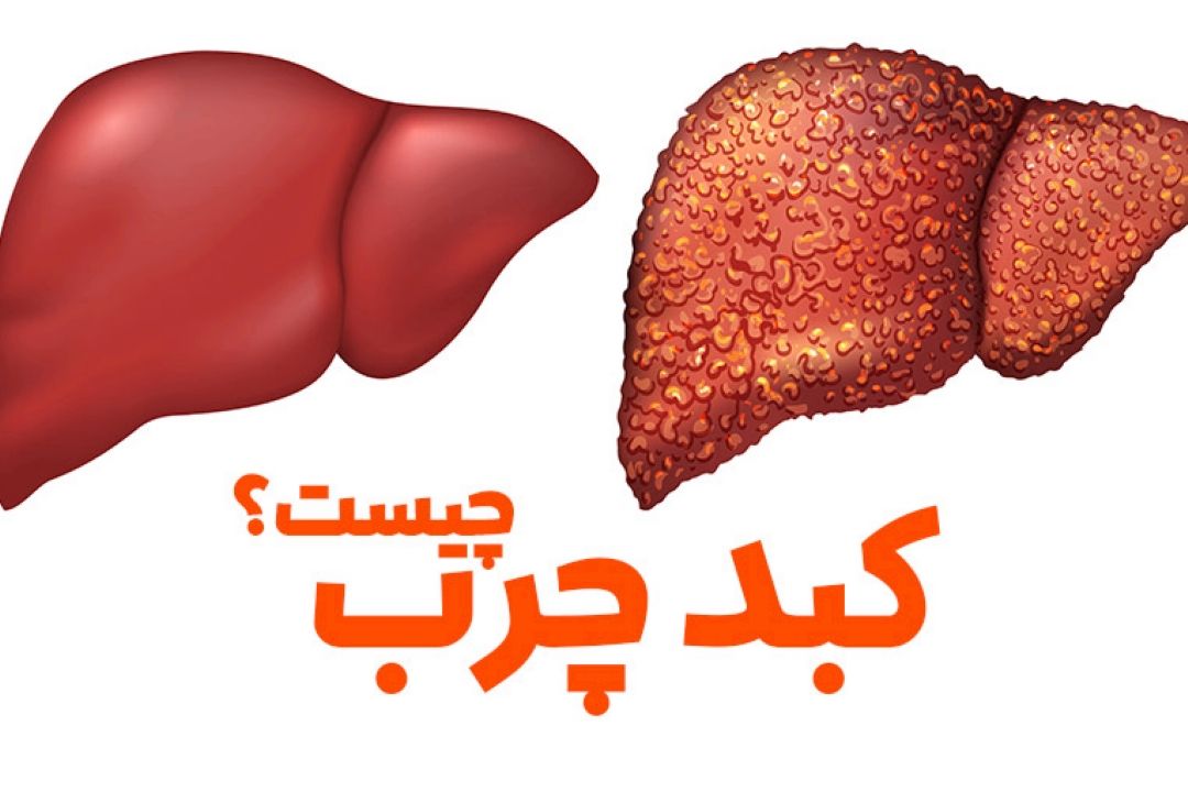 فوق تخصص گوارش و كبد: بهترین درمان كبد چرب، ورزش و رژیم و  كاهش وزن است