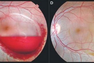 در برنامه نبض یكشنبه هفتم آبان درباره التهاب شبكیه صحبت شد