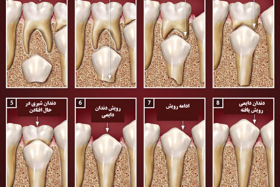 در برنامه نبض سه شنبه نهم آبان درباره دندان شیری پوسیده و كشیدن آن در نوجوانان صحبت میكنیم.