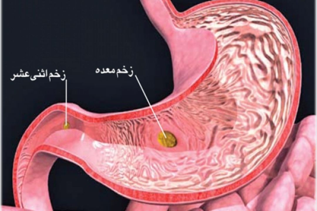 در برنامه نبض شنبه بیستم آبان درباره خونریزی داخلی و زخم اثنی عشر صحبت میكنیم