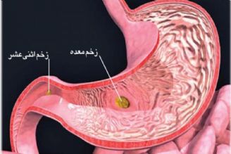 در برنامه نبض شنبه بیستم آبان درباره خونریزی داخلی و زخم اثنی عشر صحبت میكنیم