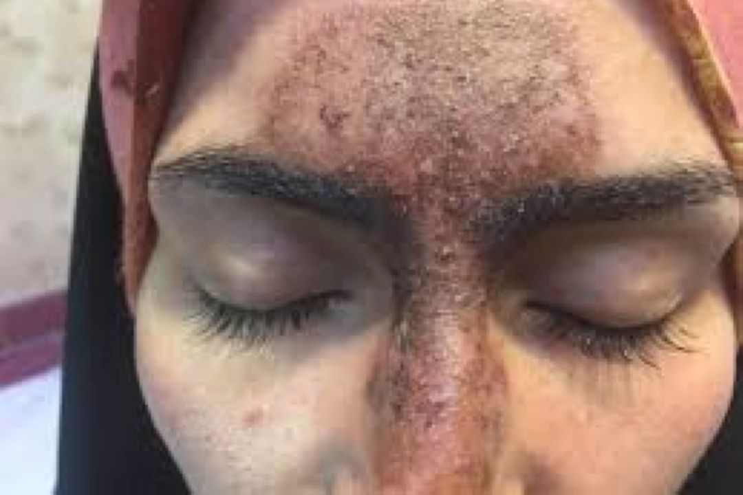 لك های قهوه ای صورت 