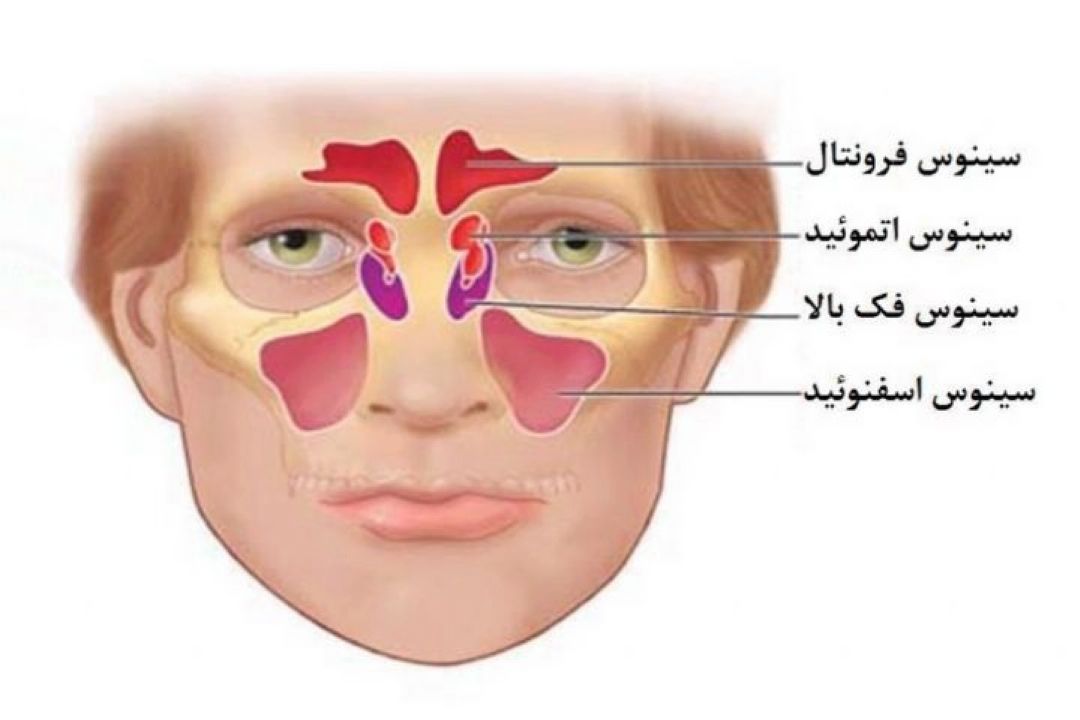 در برنامه نبض دوشنبه ششم آذر درباره سینوزیت آلرژیك صحبت شد
