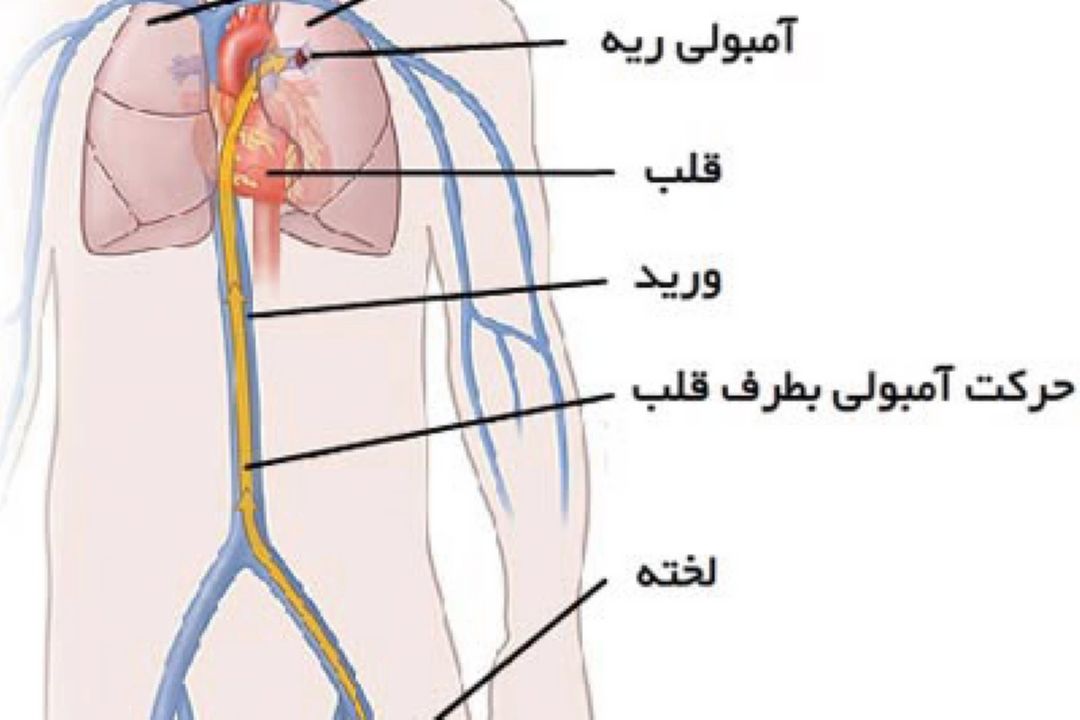 در برنامه نبض چهارشنبه هشتم آذر درباره آمبولی ریه صحبت میكنیم