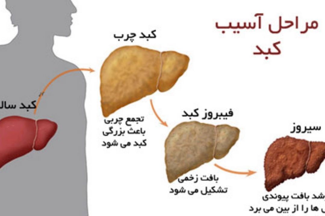 در برنامه نبض شنبه هجدهم آذر درباره كبد چرب صحبت شد