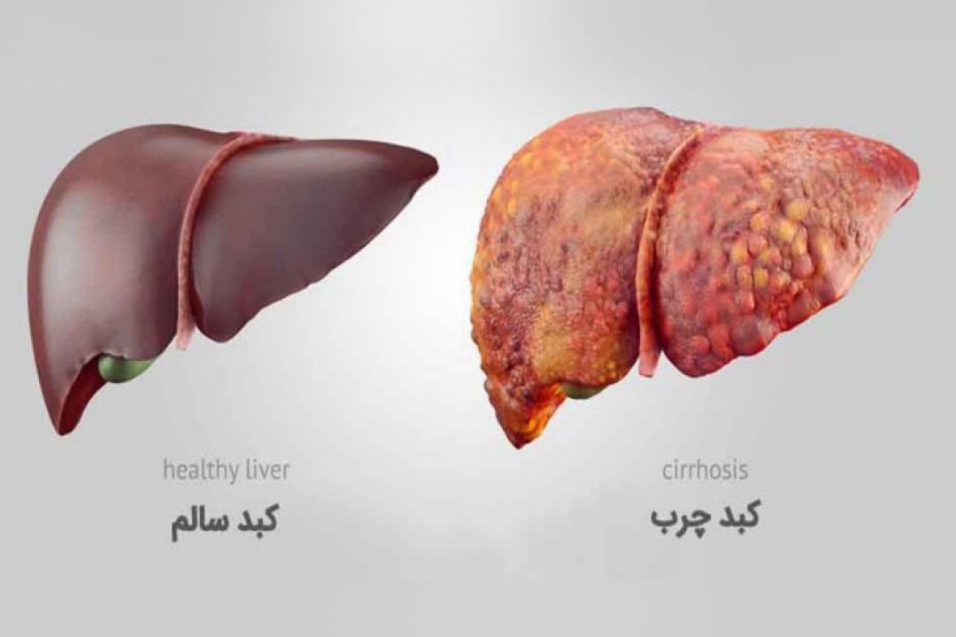 در برنامه نبض شنبه دوم دی درباره كبد چرب صحبت میكنیم