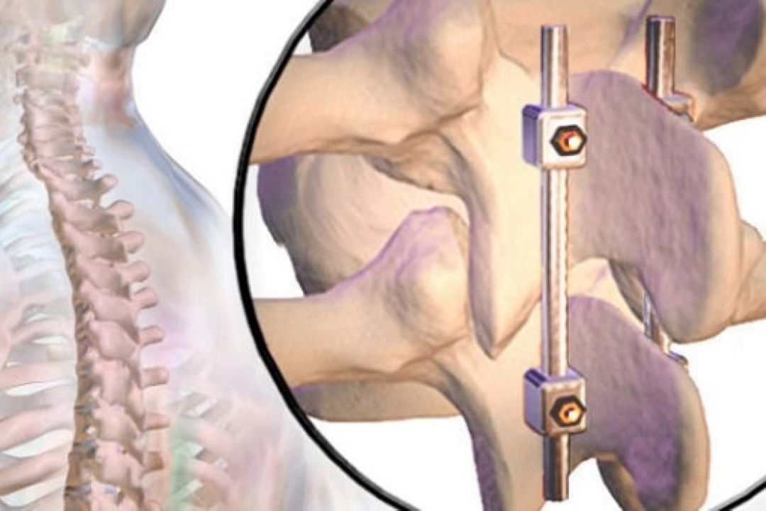 جراحی نوین فیوژن ستون فقرات با استارت آپ ایرانی 