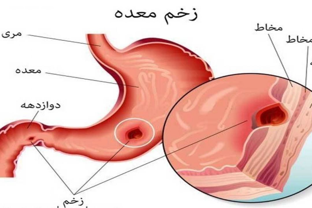 در برنامه نبض شنبه سی ام دی درباره زخم معده صحبت میكنیم.