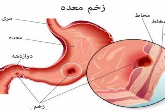 در برنامه نبض شنبه سی ام دی درباره زخم معده صحبت میكنیم.