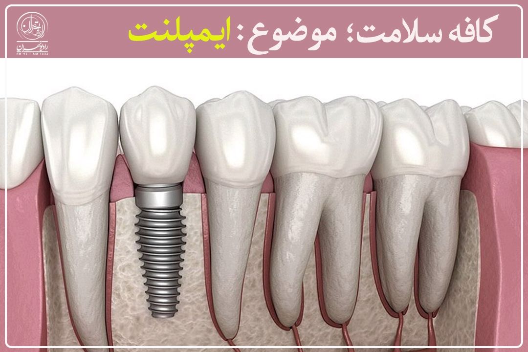 چه كسانی نمی‌توانند از ایمپلنت استفاده كنند؟