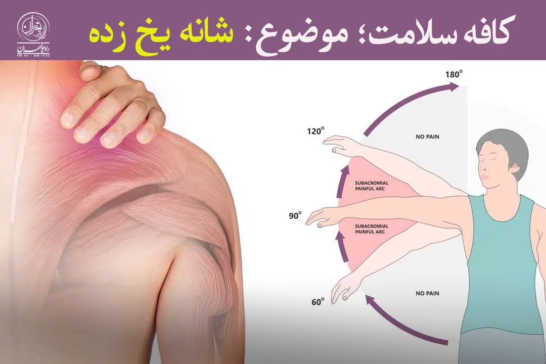 شانه یخ زده چیست و چگونه درمان می‌شود؟