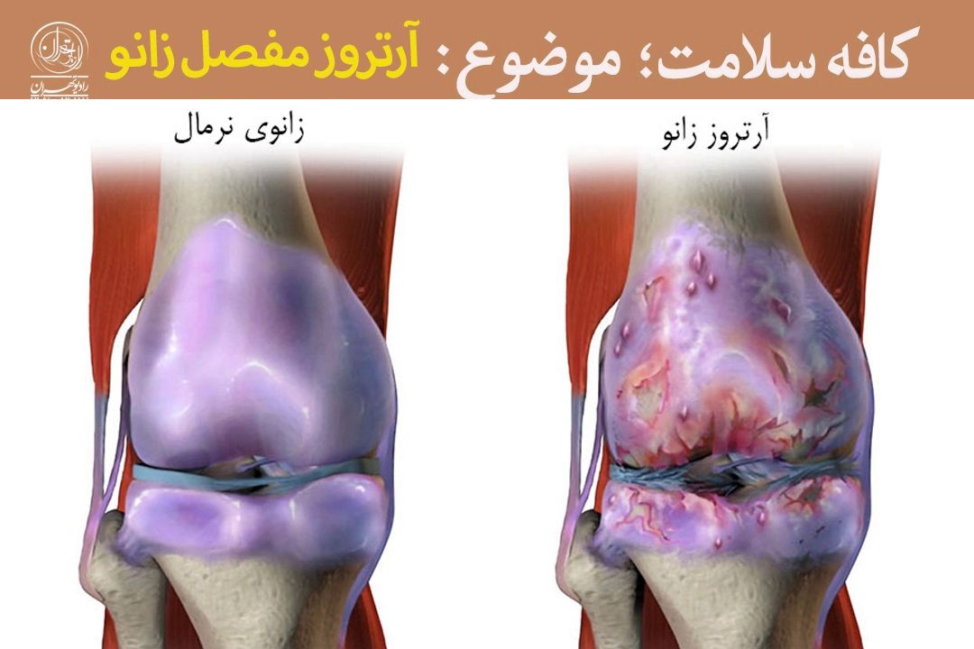 آرتروز زانو، علائم و راه‌های كنترل و درمان