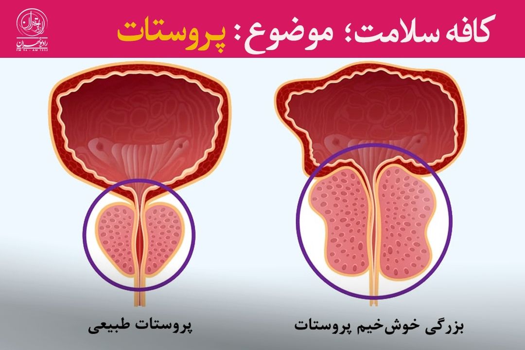 سلامت پروستات؛ اهمیت آگاهی و تشخیص به‌موقع