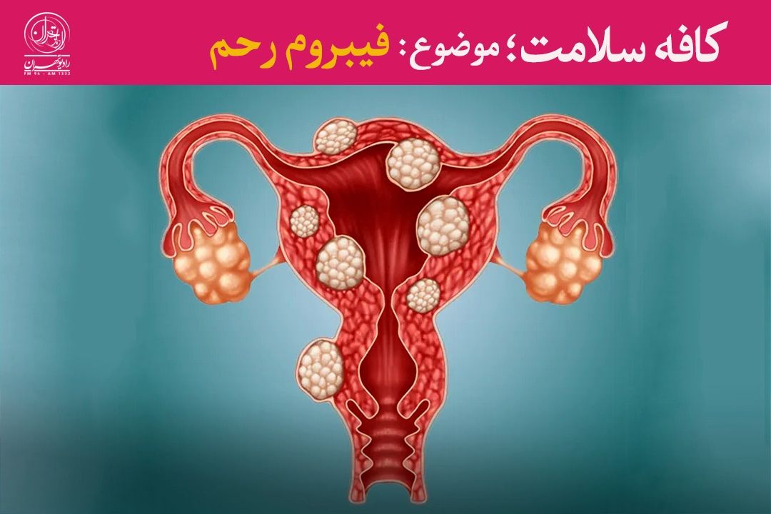 سبك زندگی و تأخیر در بارداری، عوامل پنهان رشد فیبروم‌های رحمی