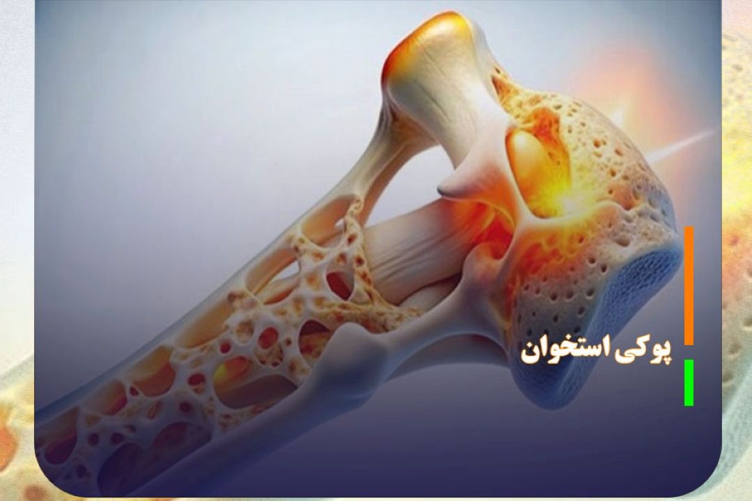 ابتلای زنان به پوكی استخوان، بیشتر از مردان