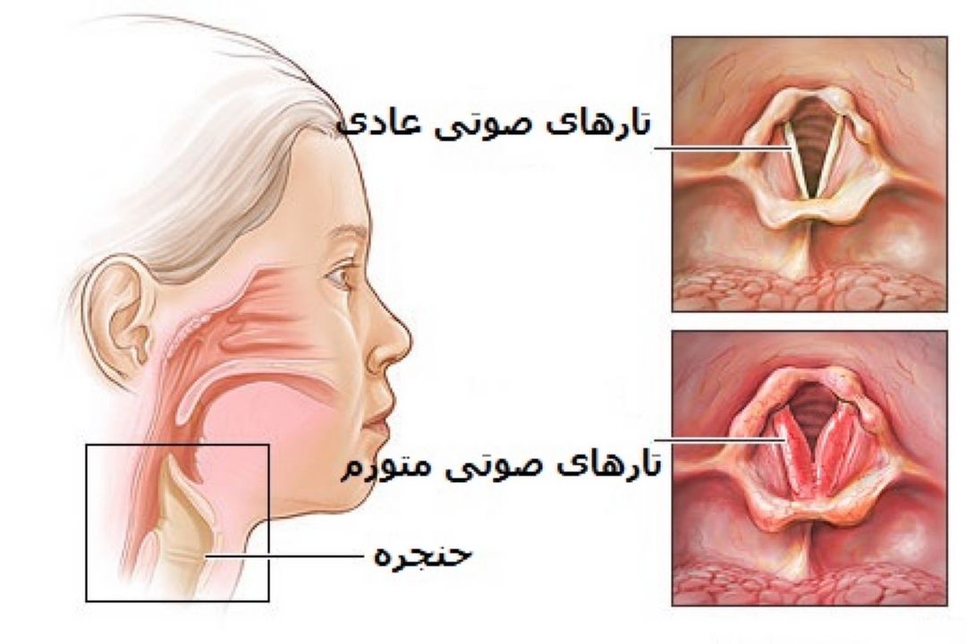 در برنامه نبض دوشنبه نهم بهمن درباره قطع صدا در اثر آلرژی صحبت شد