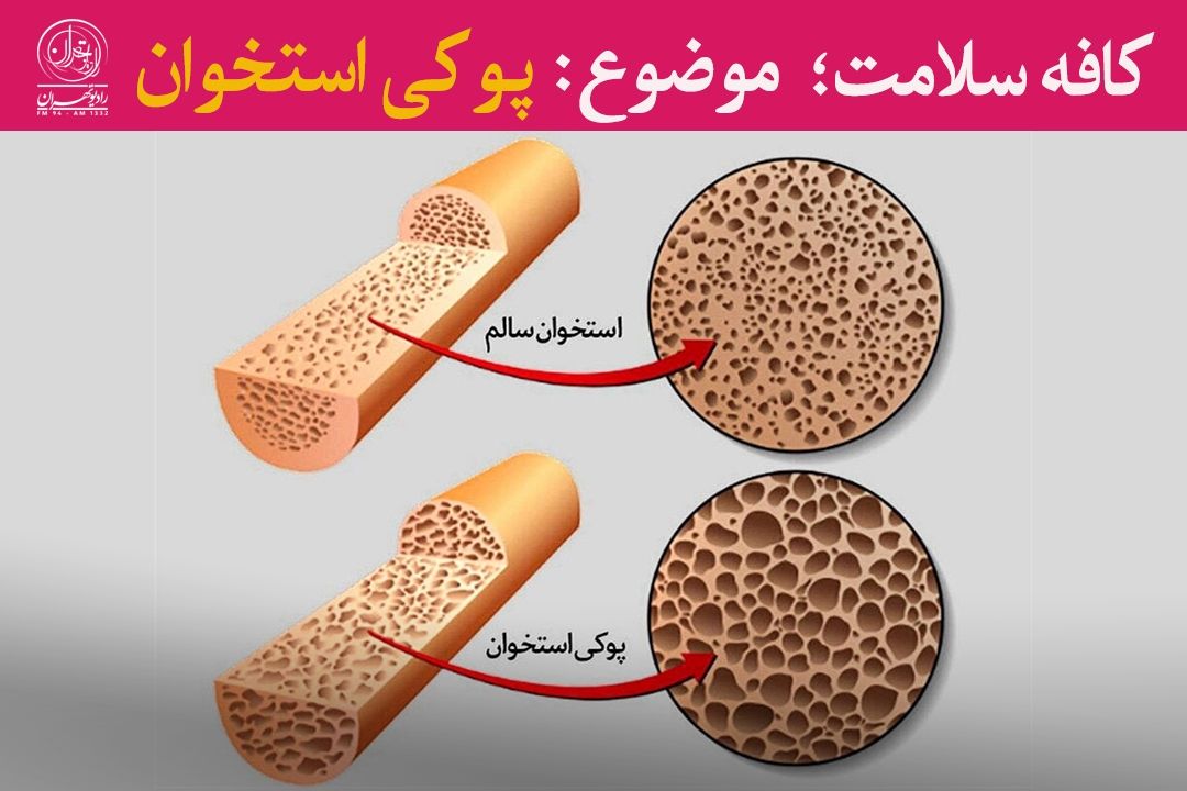  پوكی استخوان؛ دزد خاموش سلامت