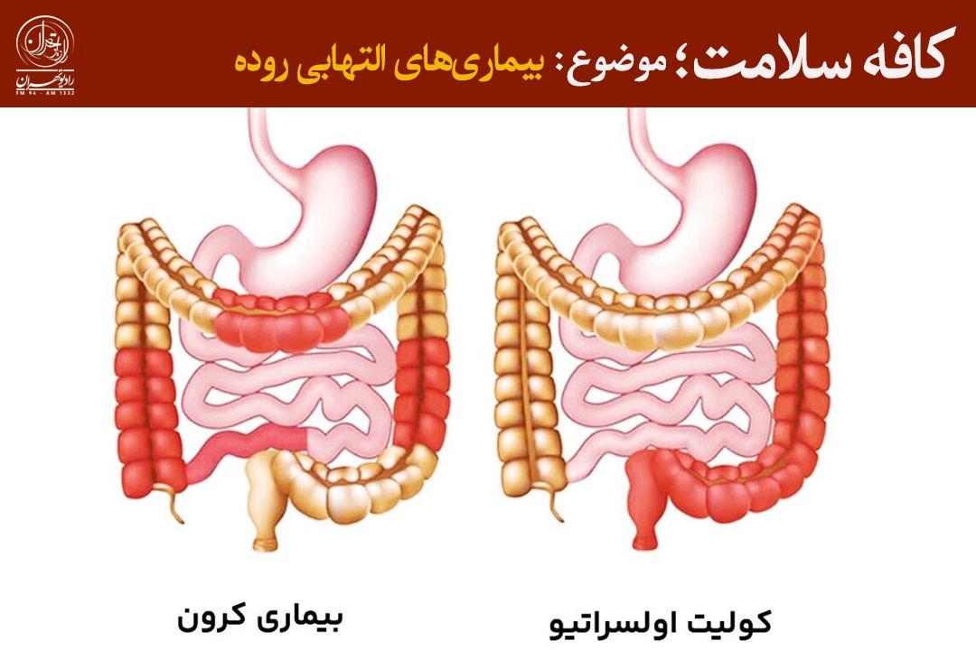 آشنایی با علائم شایع بیماری‌های التهابی روده در «كافه سلامت»