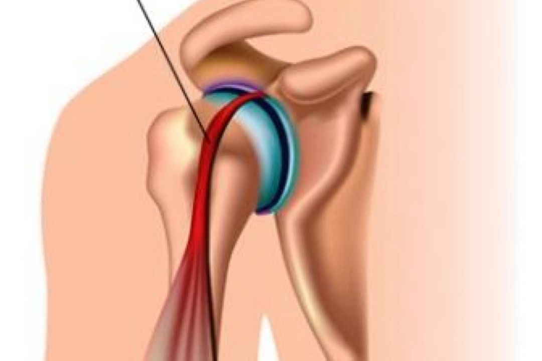 علت تاندونیت شانه و راه های درمان آن