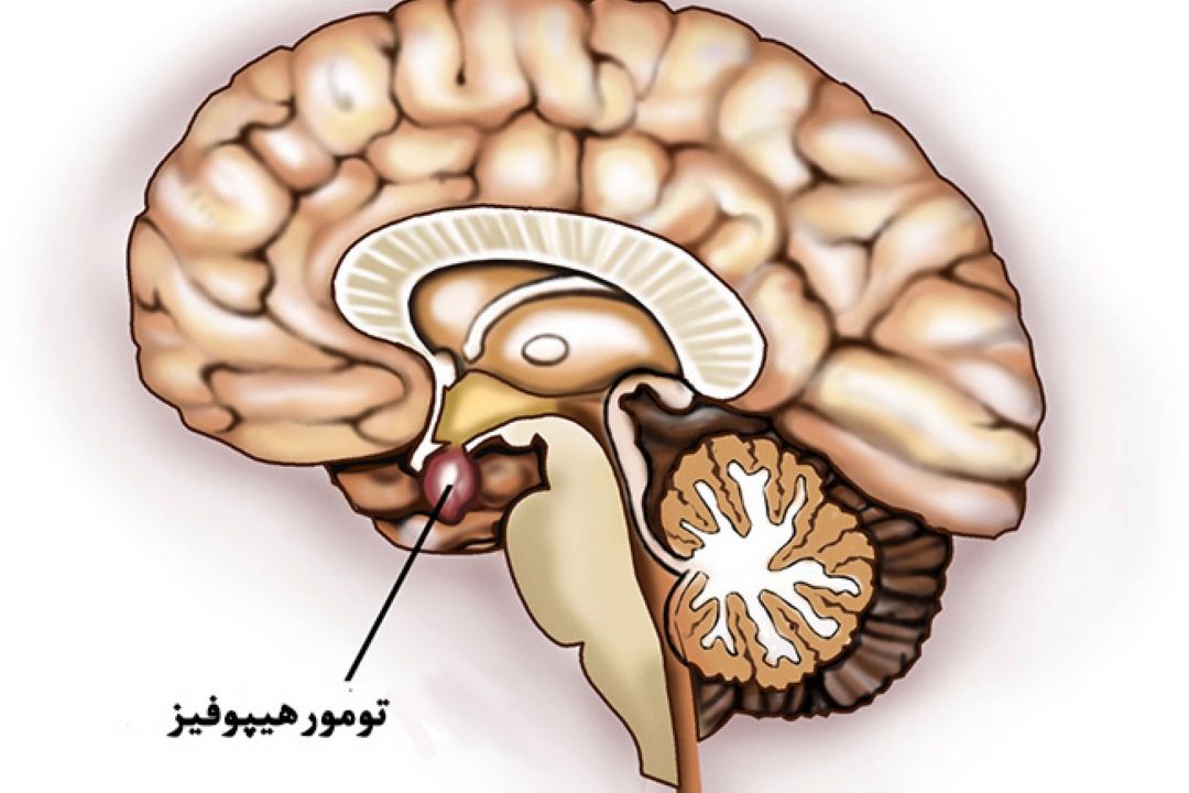 در برنامه نبض سه شنبه بیست و چهارم بهمن درباره اثر هیپوفیز سرطانی بر سلامت و دید چشم صحبت میكنیم