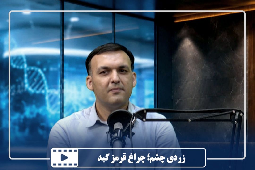 زردی چشم؛ چراغ قرمز كبد