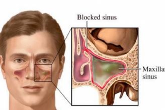 در برنامه نبض سه شنبه هشتم اسفند درباره عفونت سینوس ها در بینی جراحی شده صحبت میكنیم