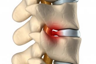 درد ناحیه كمر نشانه ای از بیماری تنگی كانال نخاع  