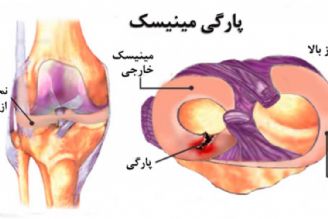 علل پارگی مینیسك زانو و روش درمان 