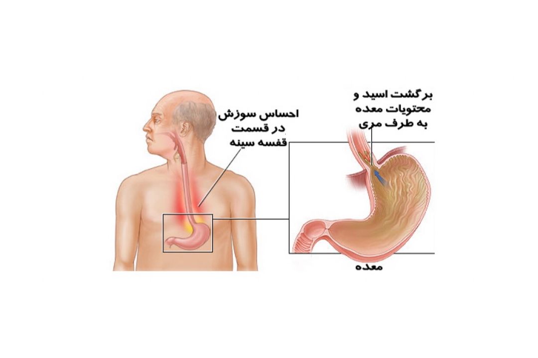 در برنامه نبض دوشنبه بیستم فروردین درباره ریفلاكس معده و سوختگی حنجره صحبت میكنیم