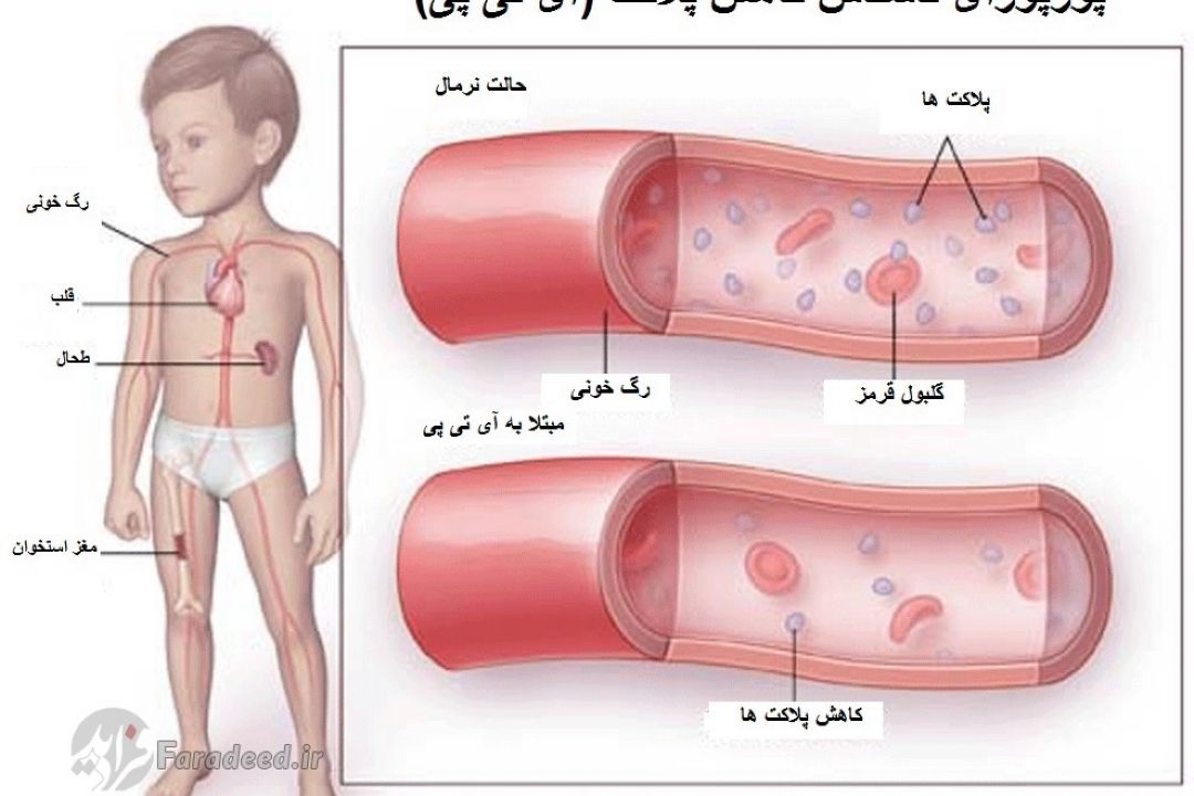 در برنامه نبض سه شنبه چهارم اردیبهشت درباره  بیماری itp كودكان صحبت شد