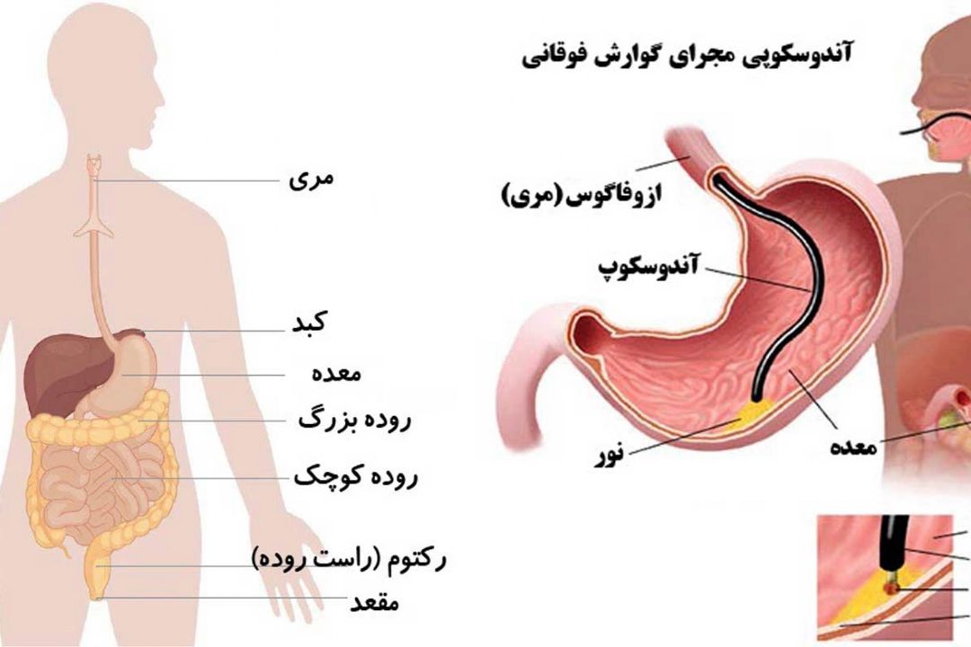 در برنامه نبض دوشنبه هفدهم اردیبهشت درباره آندوسكوپی صحبت شد