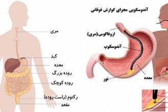 در برنامه نبض دوشنبه هفدهم اردیبهشت درباره آندوسكوپی صحبت شد