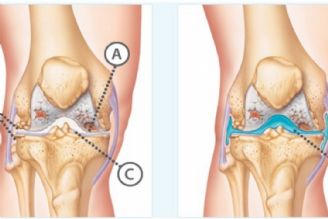 روش های درمانی آرتروز مفصل زانو 