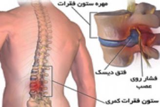 روش های درمانی در فتق دیسك كمر