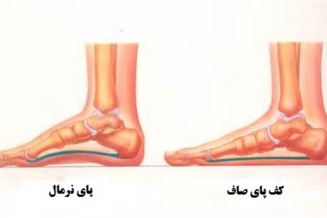 روش تشخیص كف پای صاف و عوارض این ناهنجاری 