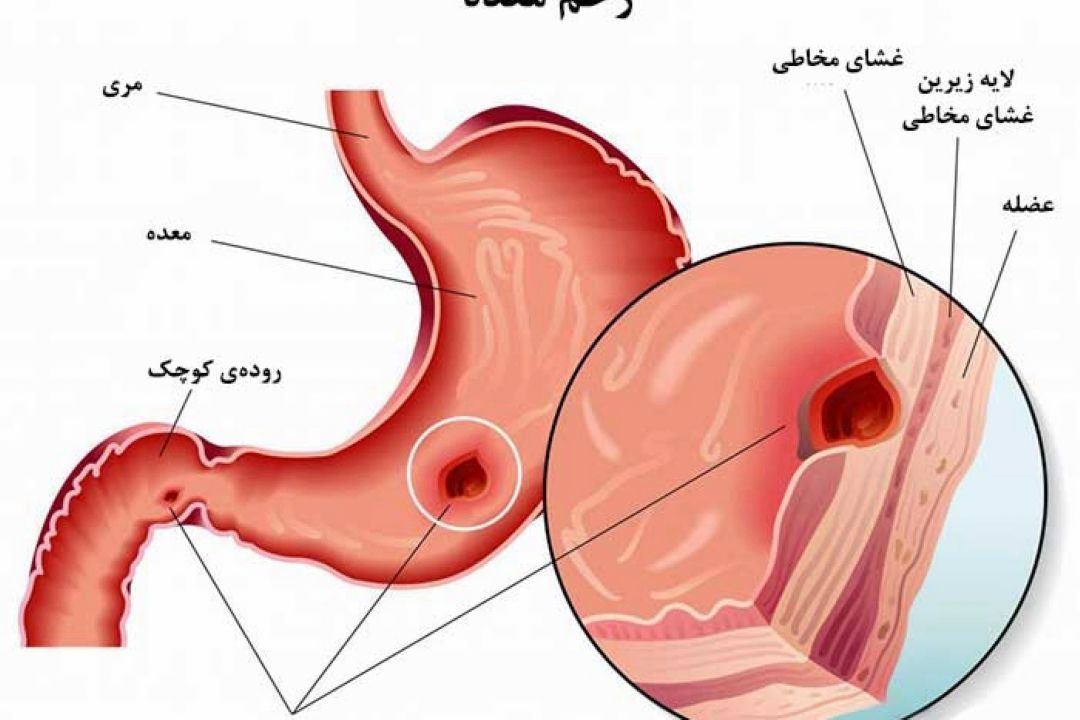 در برنامه نبض دوشنبه بیست و دوم مرداد درباره سرطان و زخم معده صحبت میكنیم