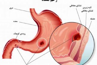 در برنامه نبض دوشنبه بیست و دوم مرداد درباره سرطان و زخم معده صحبت میكنیم