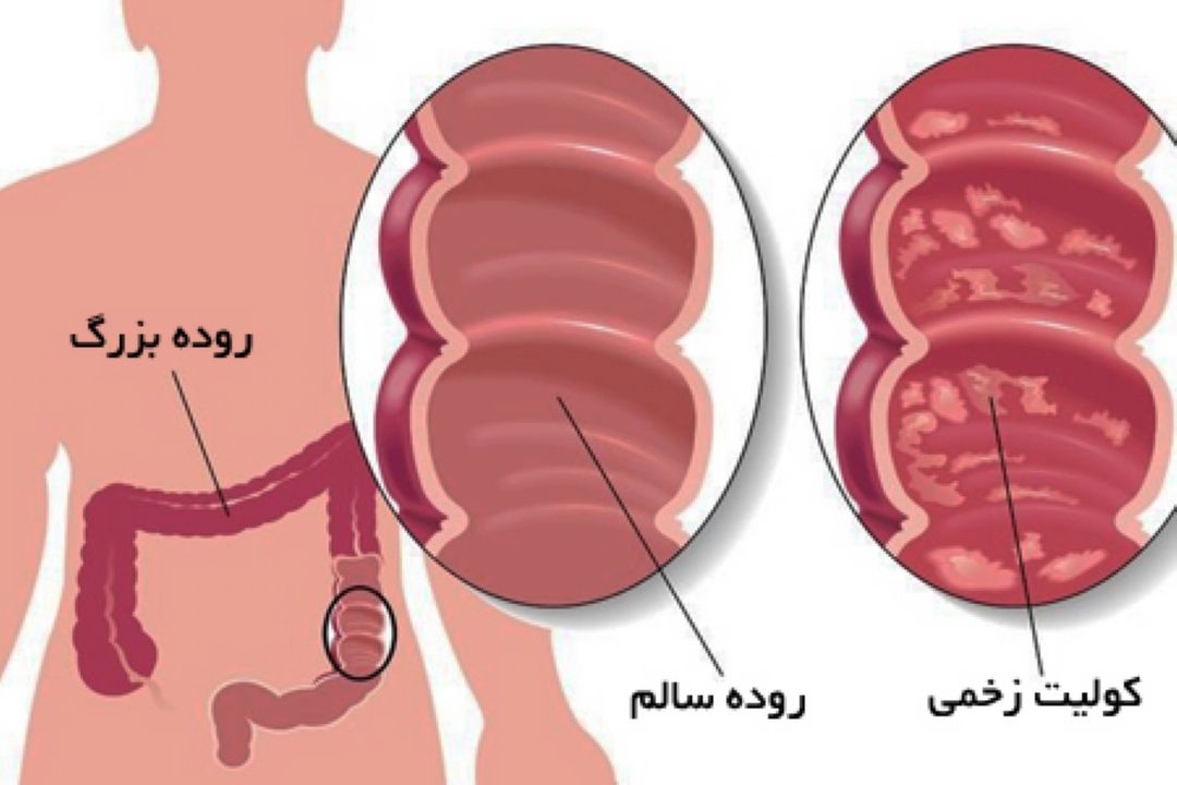 سرطان روده بزرگ 