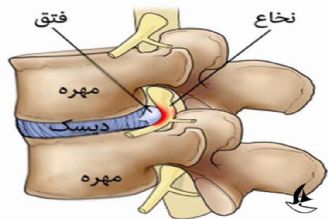 در برنامه نبض سه شنبه سوم مهر درباره درمان دیسك كمر صحبت شد
