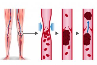 لخته شدن خون در پاها و روش های پیشگیری از آن