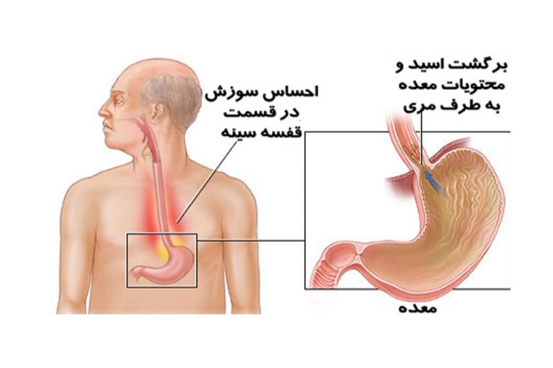 در برنامه نبض دوشنبه سی ام مهر درباره ریفلاكس معده  صحبت میكنیم