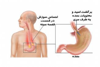 در برنامه نبض دوشنبه سی ام مهر درباره ریفلاكس معده  صحبت میكنیم