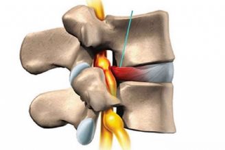 پیشگیری و درمان اختلال دیسك كمر